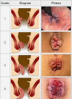 Illustration for article titled obat ambeien atau wasir